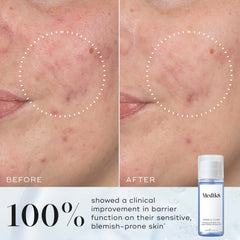 Antes y después Medik8 Press and Clear