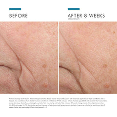 Resultados antes y después con Triple Lipid Restore en piel madura